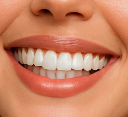 تبييض الاسنان